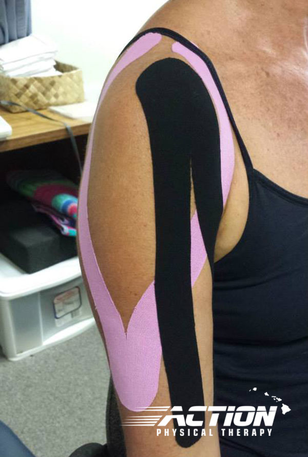Lady with pink and black Kinesiology Tape on shoulder and bicep.