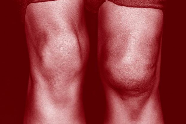 A close up of a swollen knee injured in sports